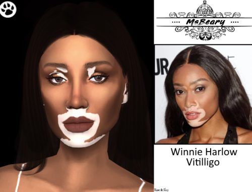 Winnie Harlow Vitiligo Skin Pattern