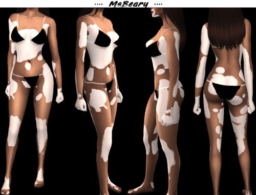 Winnie Harlow Vitiligo Skin Pattern