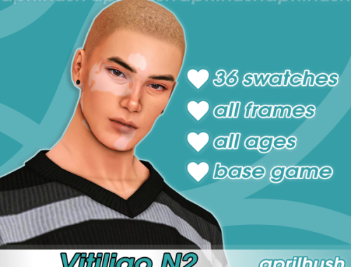 Vitiligo N2