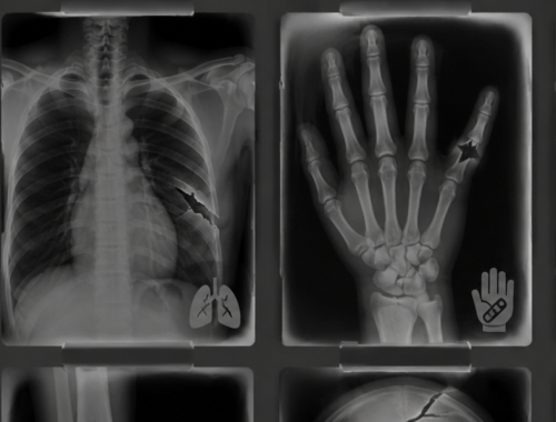 Yk X-ray Collection: Fractures And Injuries